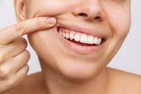 Cavities No More: What to Expect from a White Filling Treatment